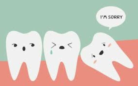 Dr. Fanous’ Wisdom Teeth Removal Tips